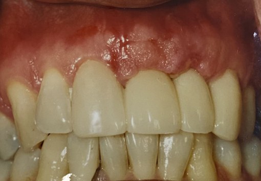 1.1-After-Enhancement of Gingiva Between Teeth