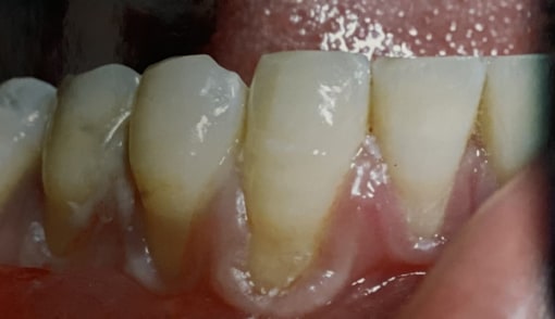 1-Before-Gum Graft