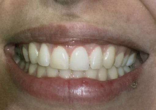 1.1-After-Gummy Smile