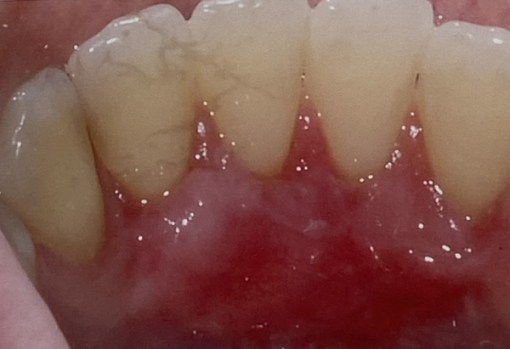 1.1-After-Lingual recession Graft