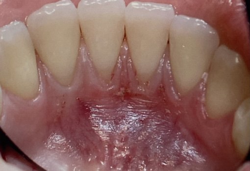 1-Before-Lingual recession Graft