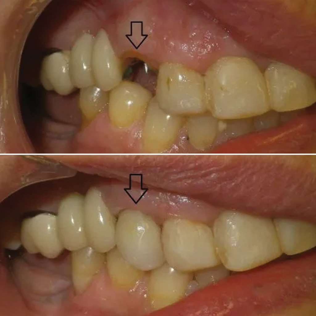1 CEREC crown