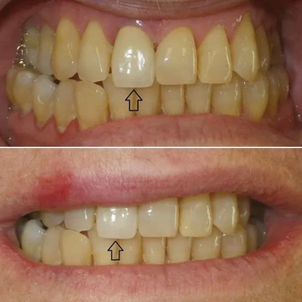 1 CEREC crown