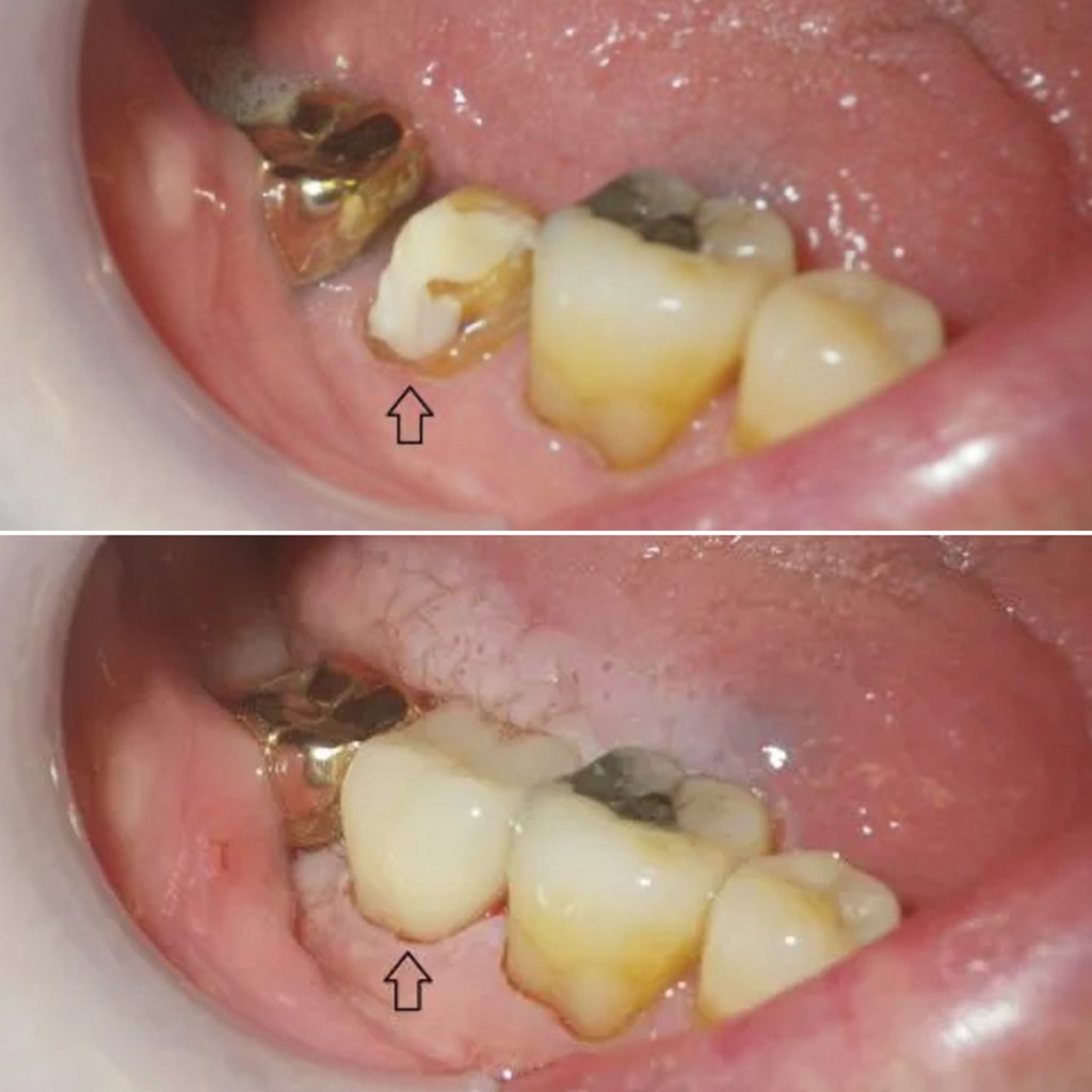 1 CEREC crown