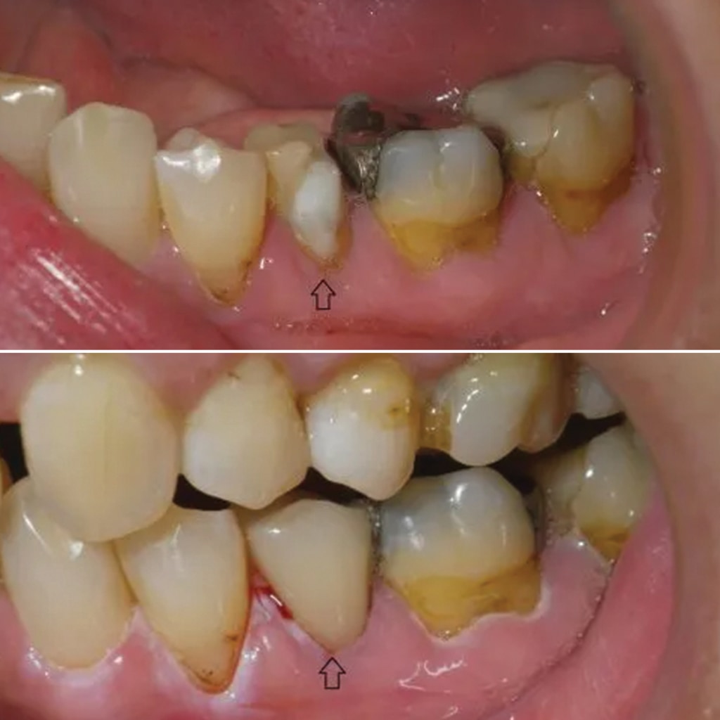 1 CEREC crown