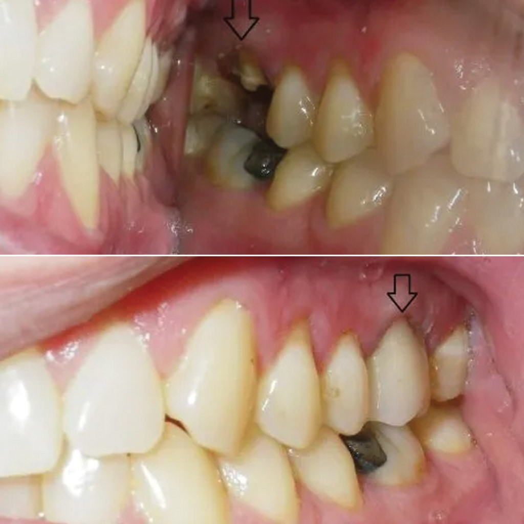 1 CEREC crown