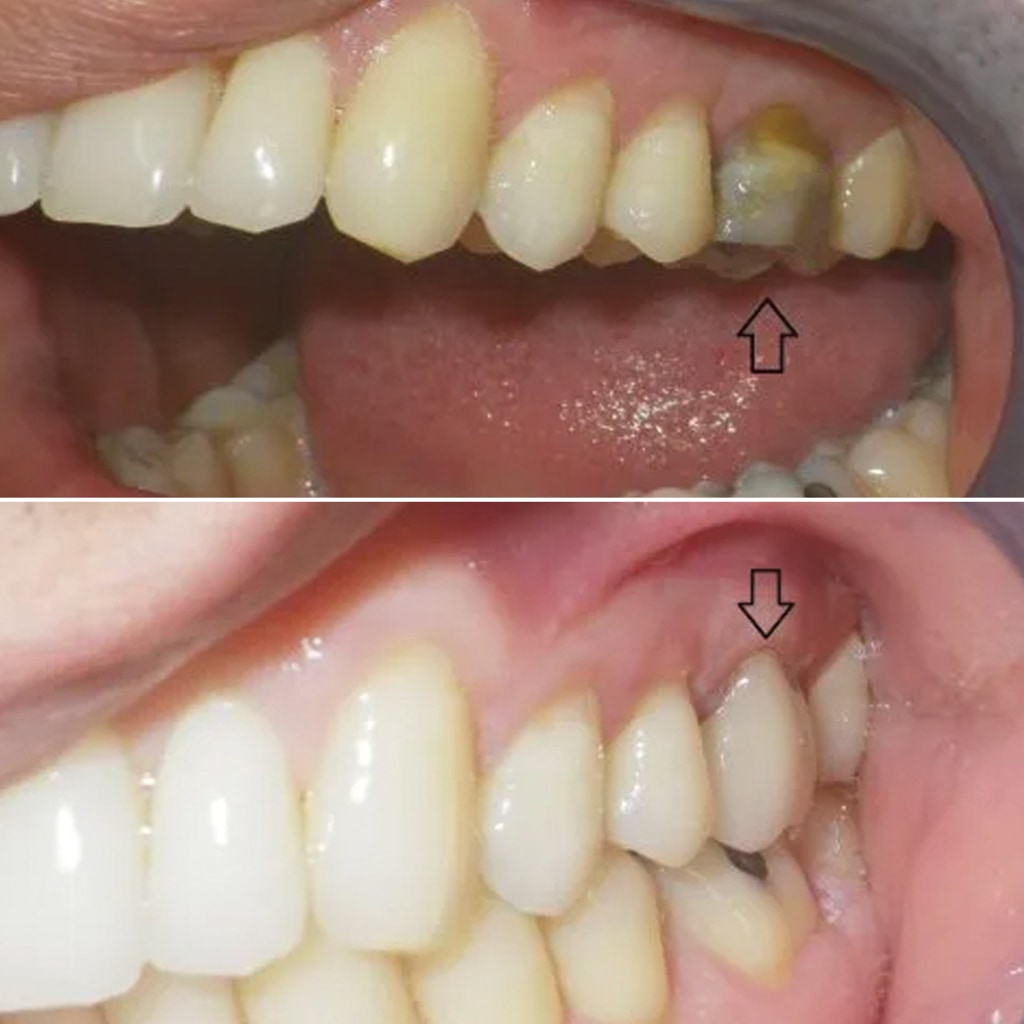 1 CEREC crown