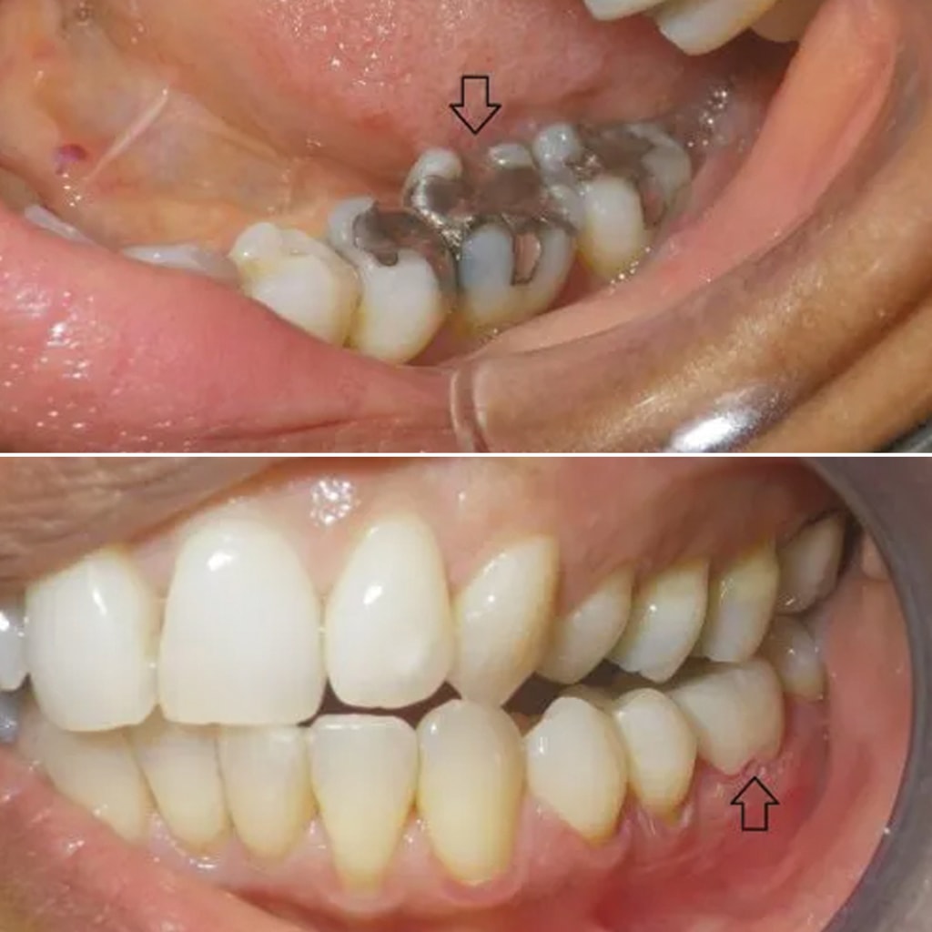1 CEREC crown