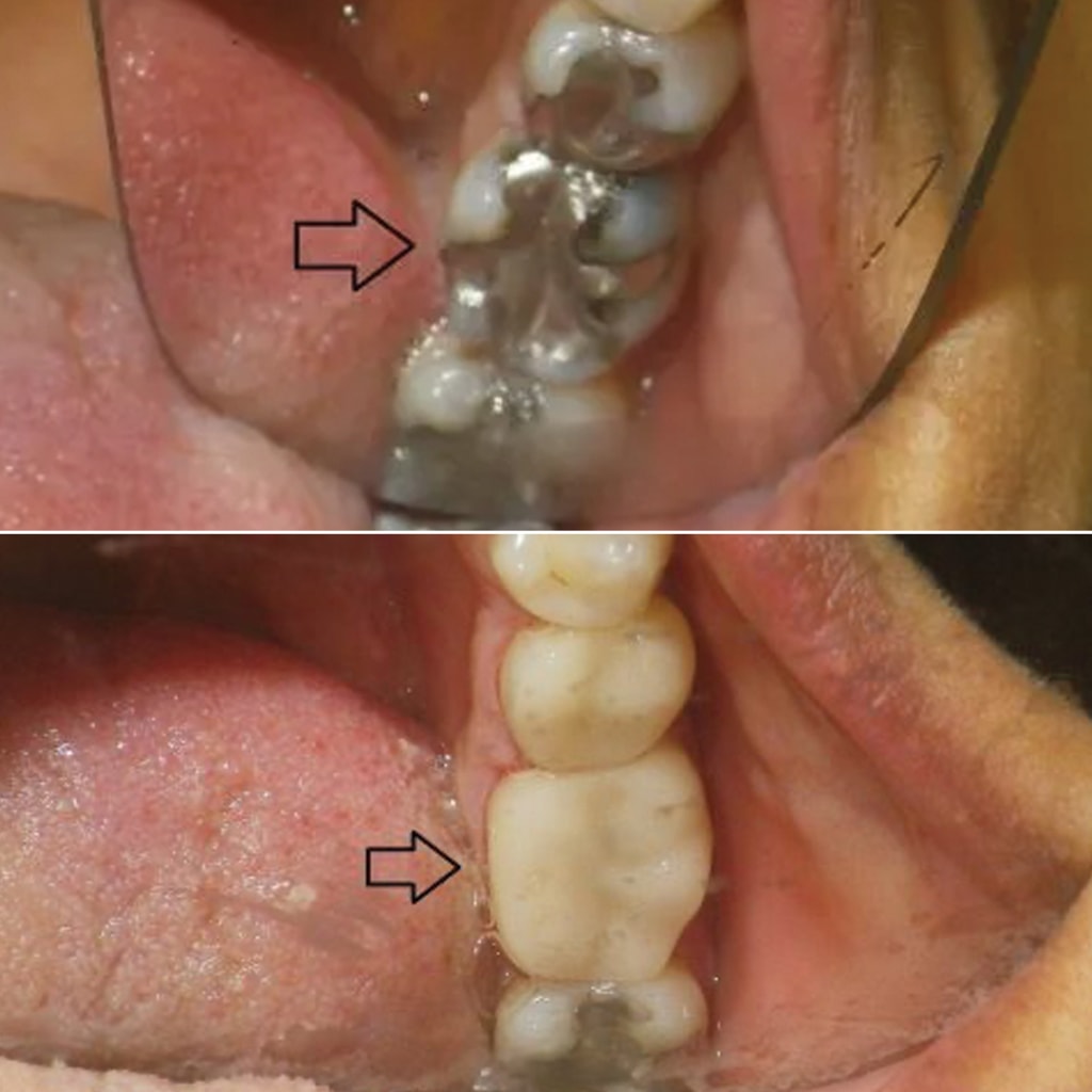 1 CEREC crown