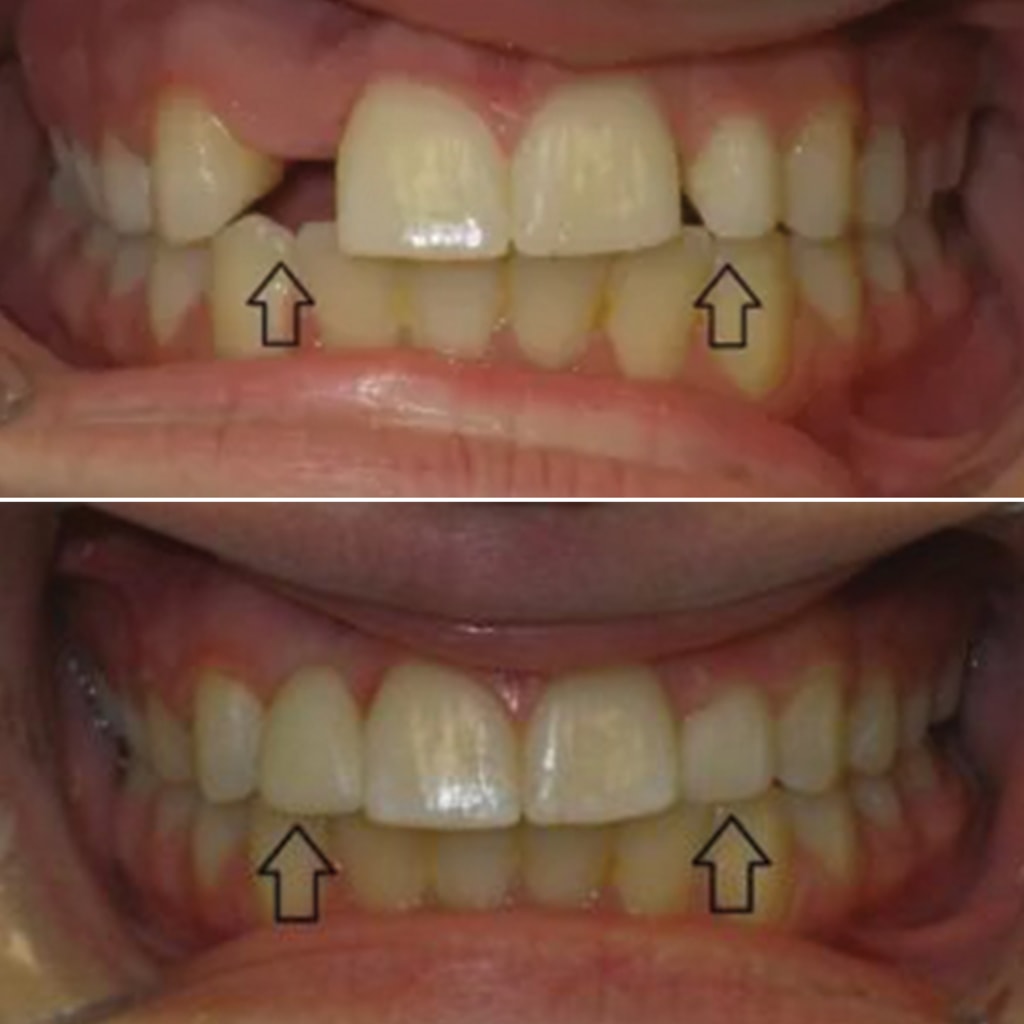 1 CEREC crown and dental bonding
