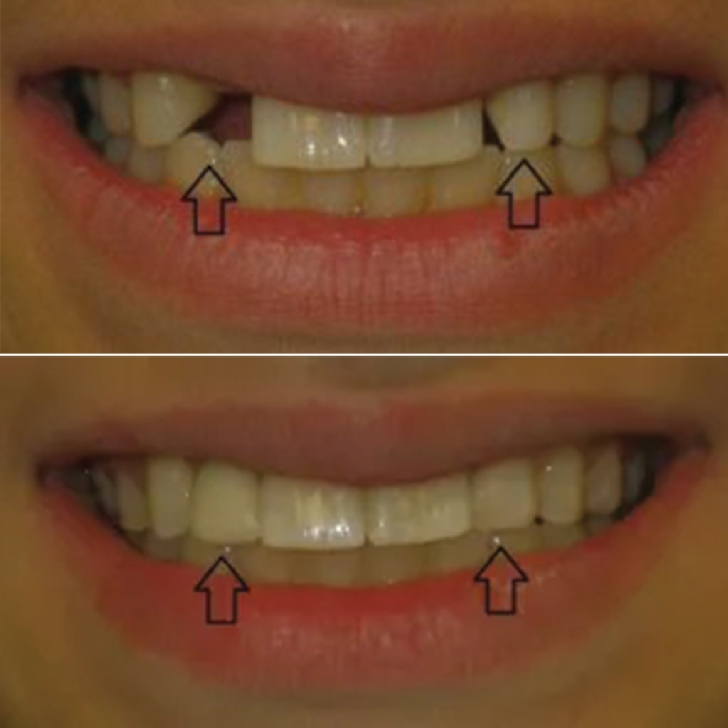 1 CEREC crown and dental bonding