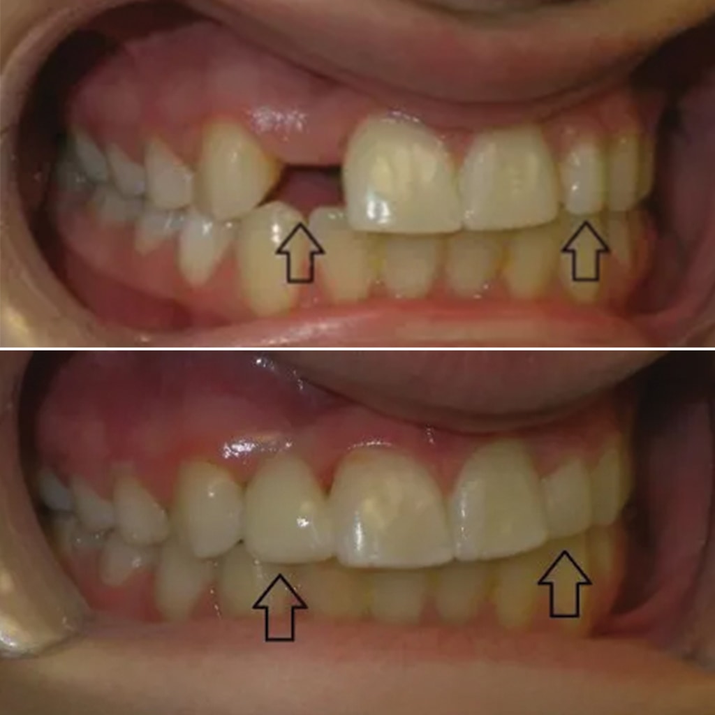 1 CEREC crown and dental bonding