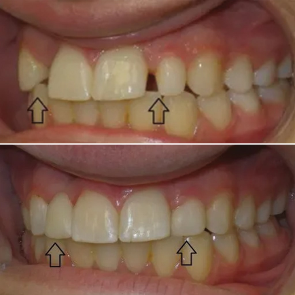 1 CEREC crown and dental bonding