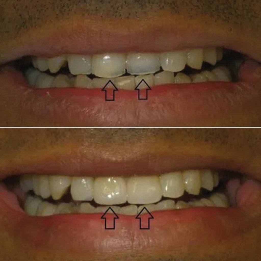 2 Front Teeth crowns