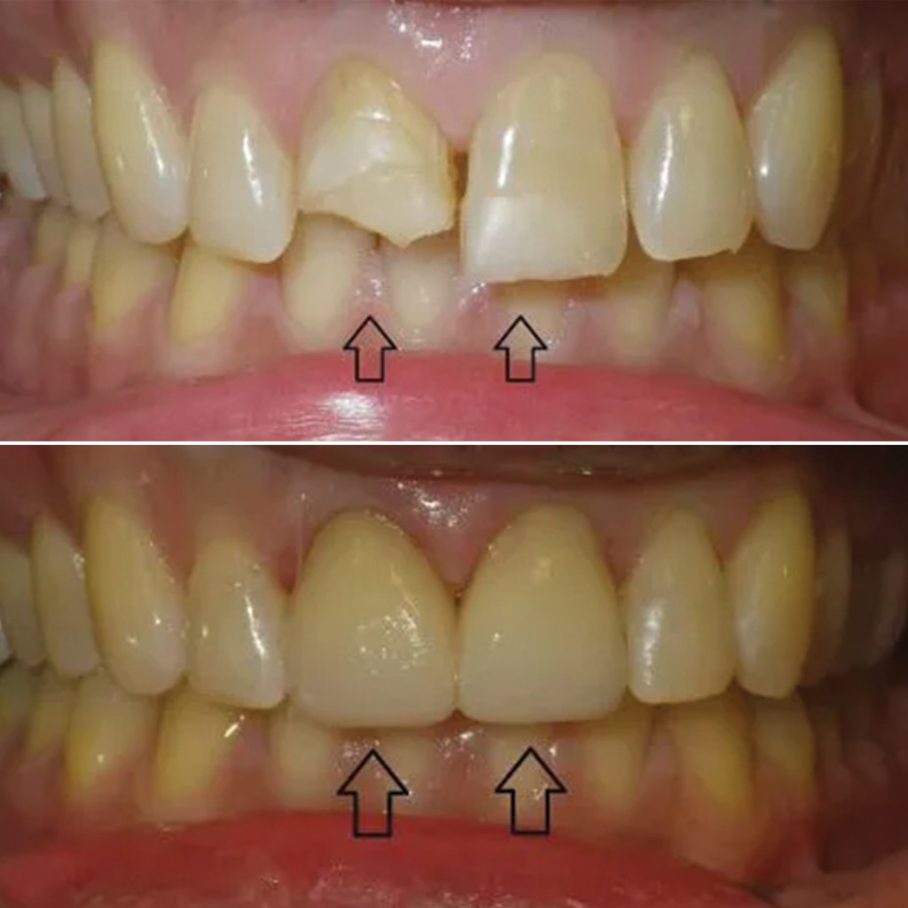 2 Front Teeth crowns