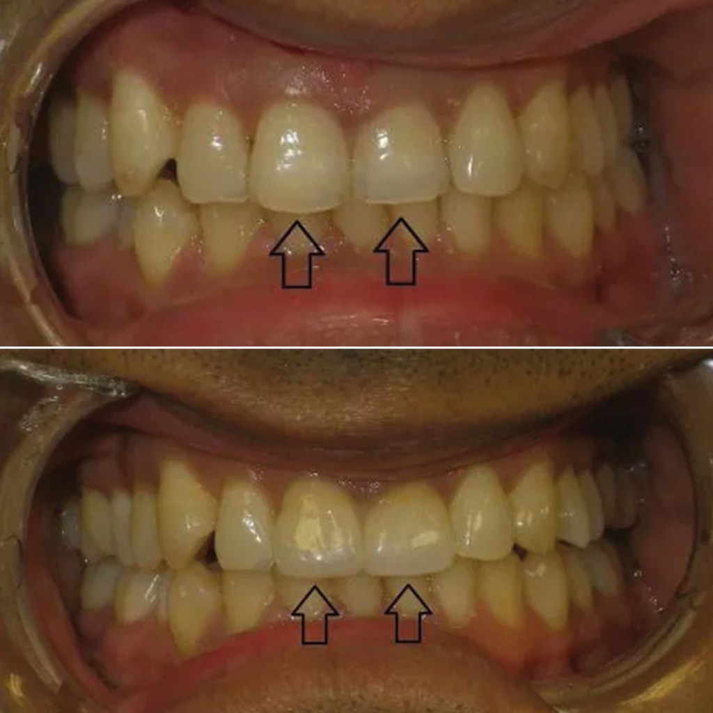 2 Front Teeth crowns