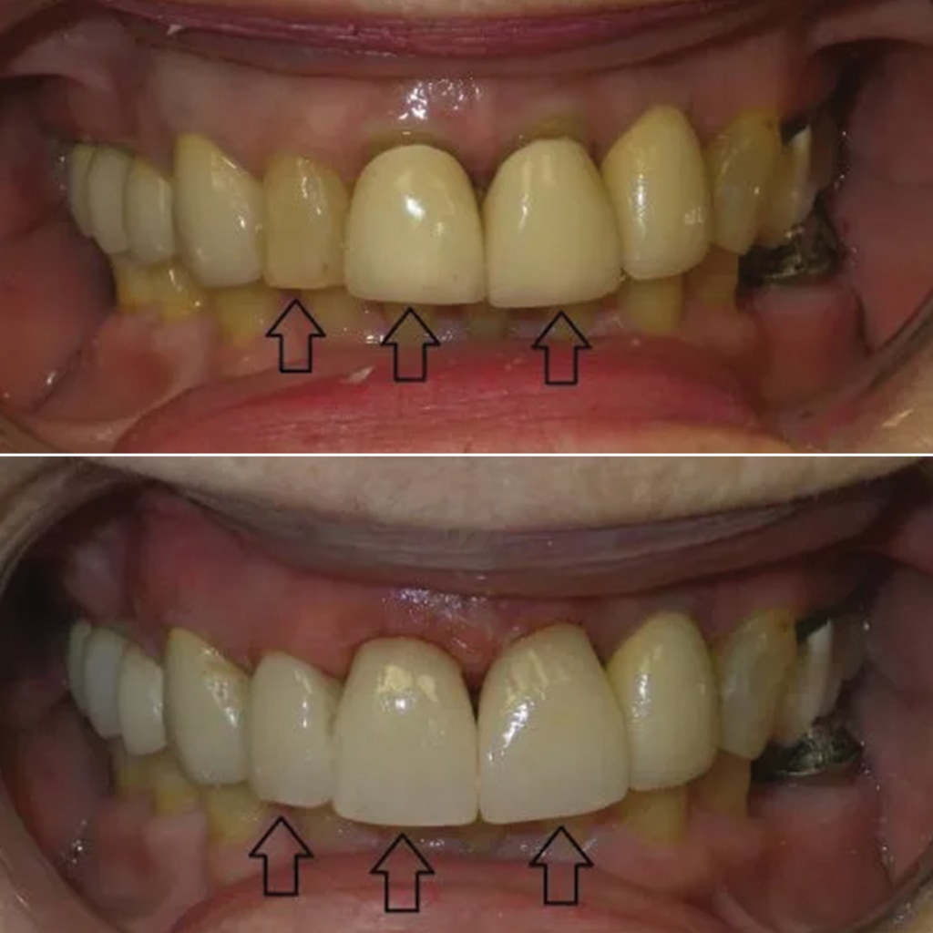 3 CEREC crowns