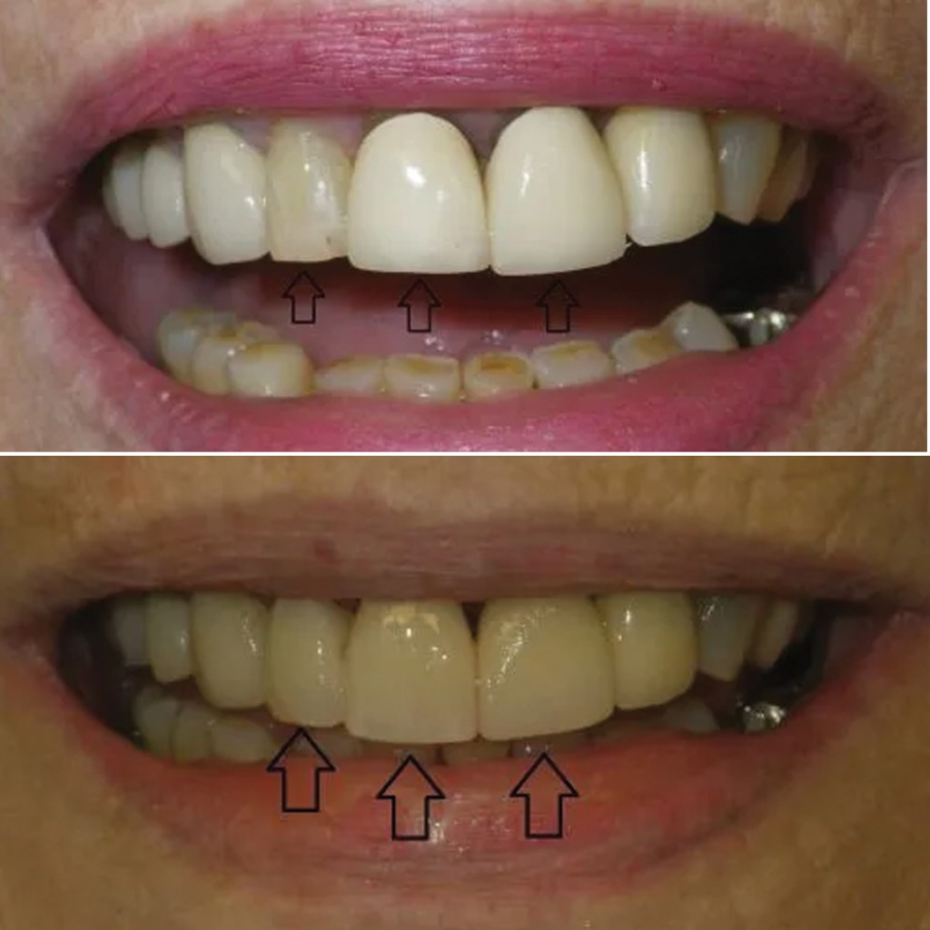 3 CEREC crowns