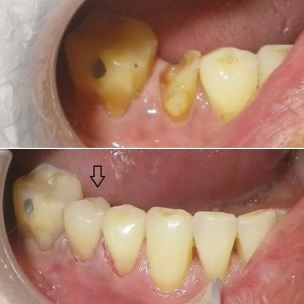 1 crown, 1 appointment