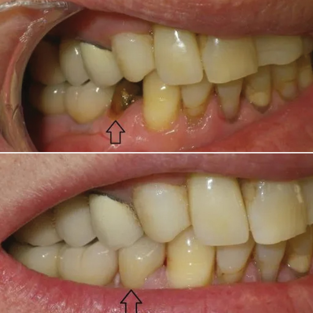 Single bottom tooth CEREC crown