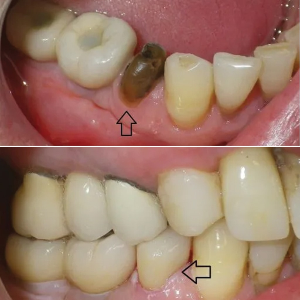 Single bottom tooth CEREC crown