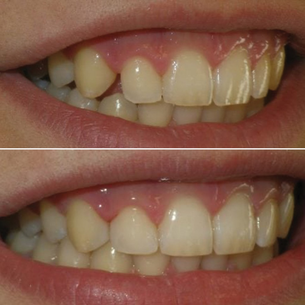 Direct in-office bonding