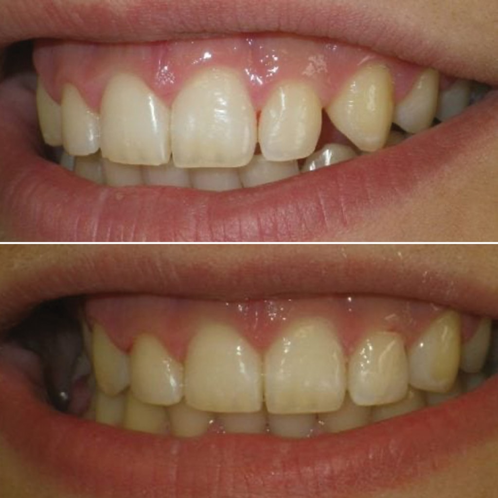 Direct in-office bonding