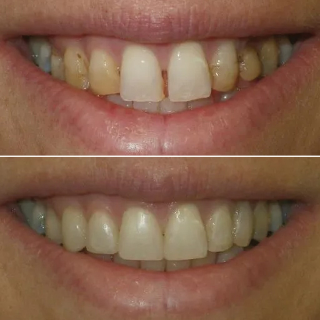 In-office direct bonding- 6 front teeth