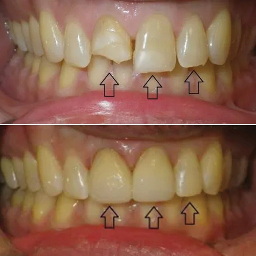 2 Front Teeth Crowns and Bonding
