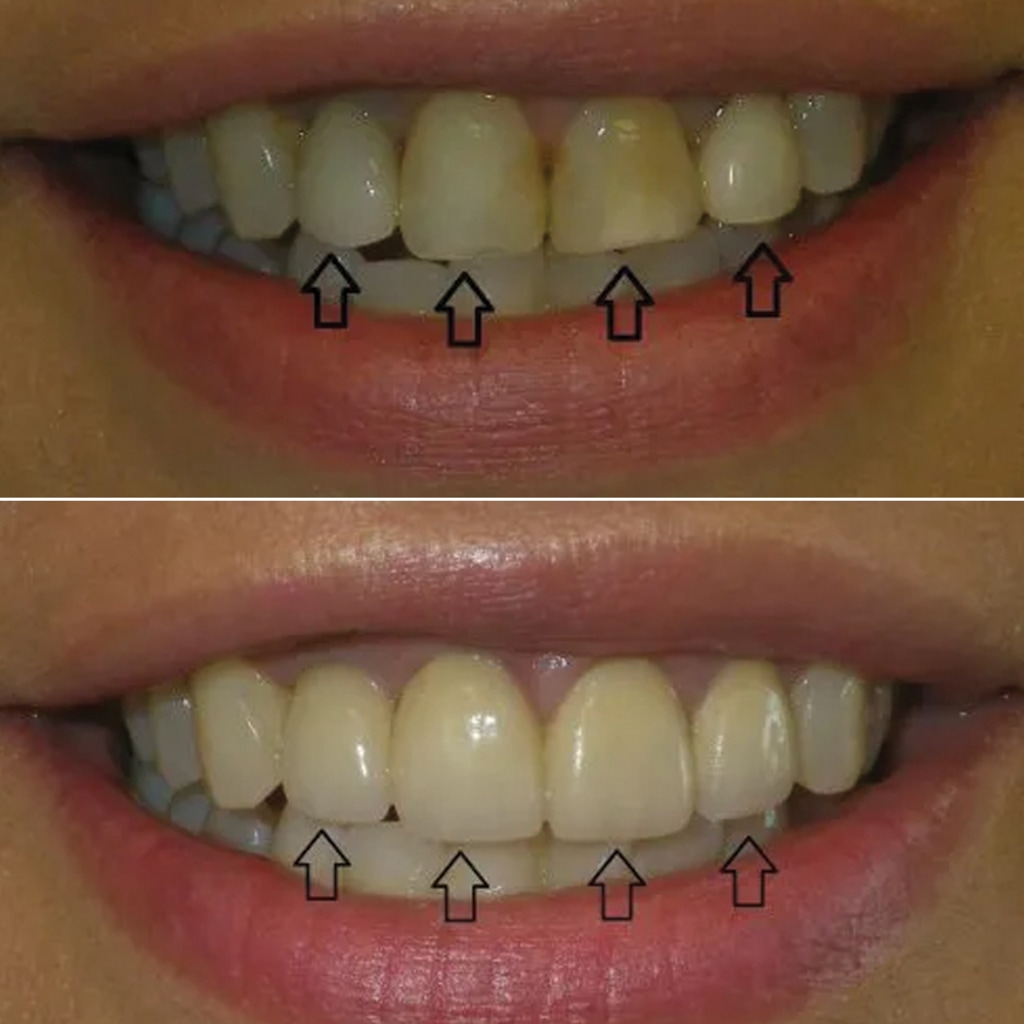 3 Crowns and 1 Implant Crown