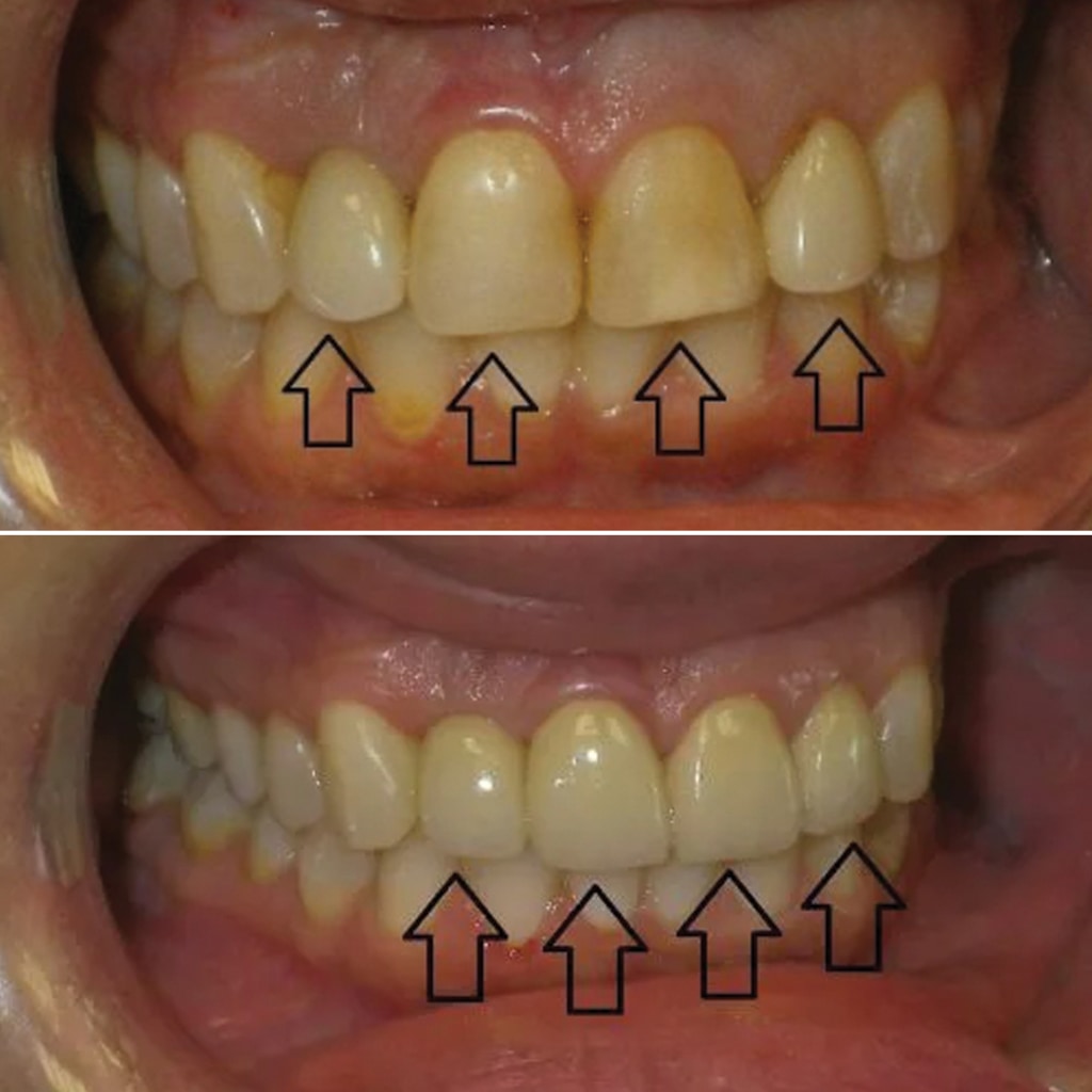 3 Crowns and 1 Implant Crown