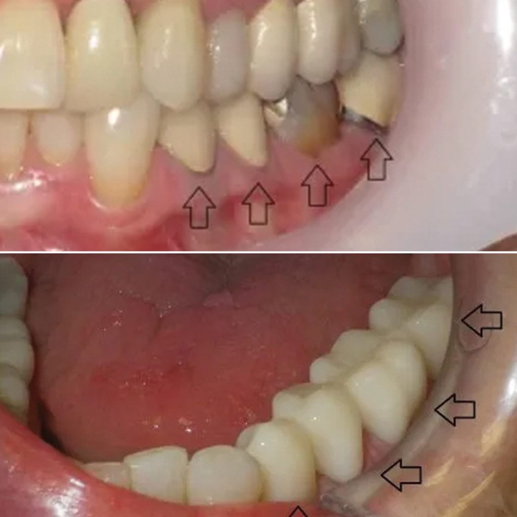 3 Crowns and Bridgework