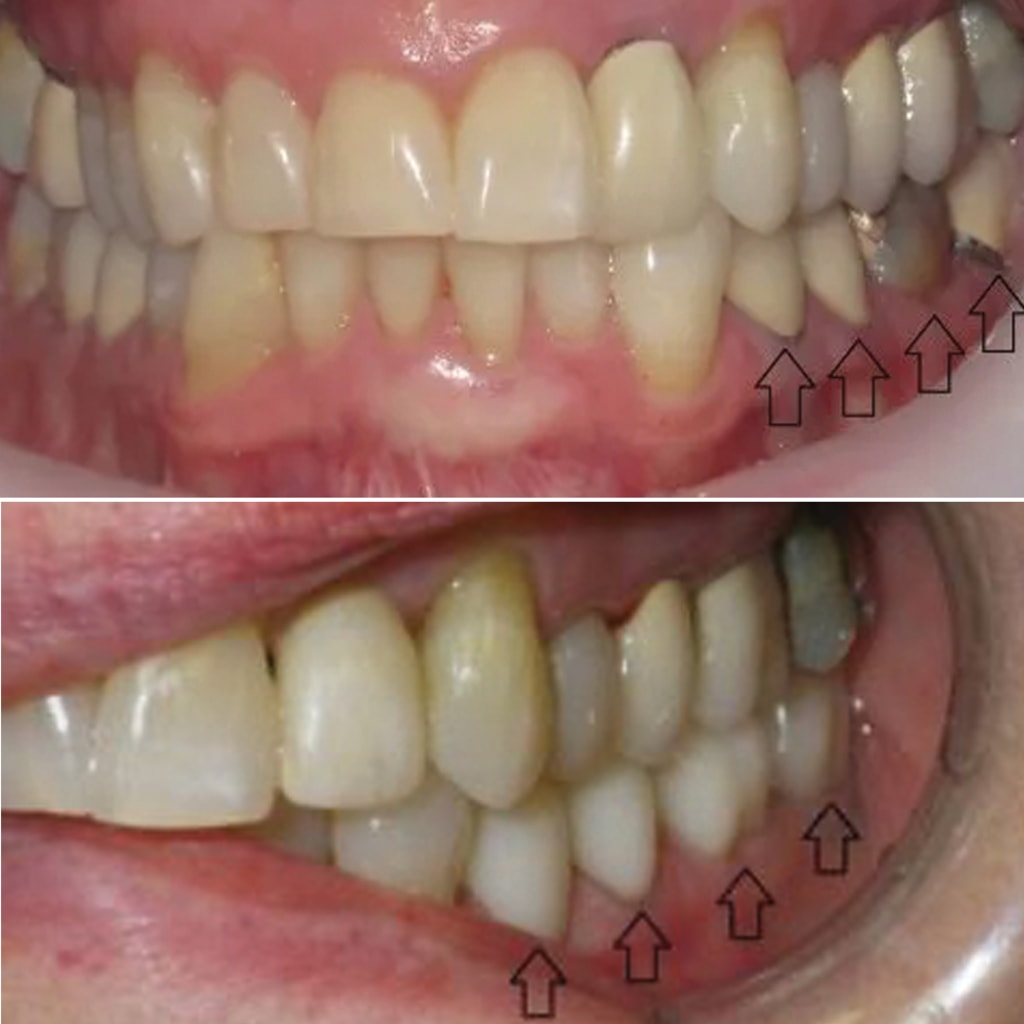 3 Crowns and Bridgework