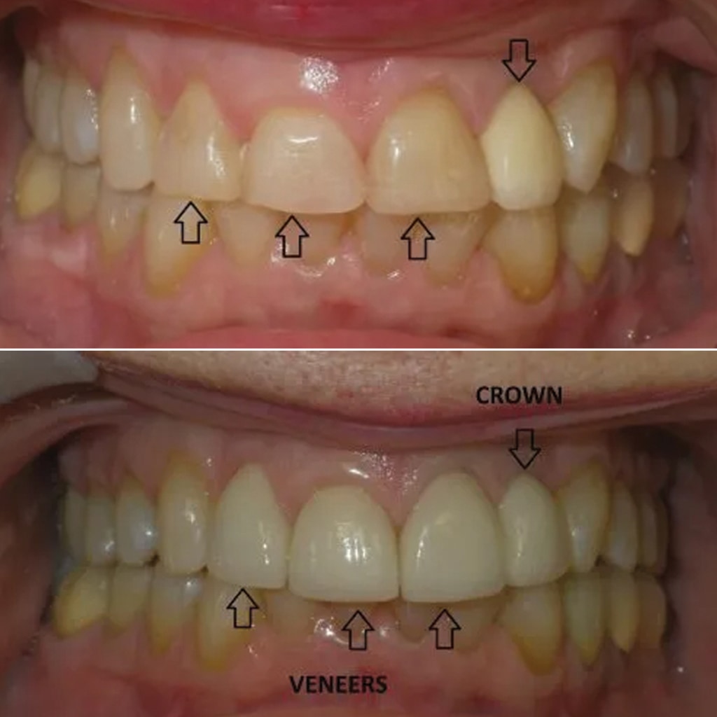 3 Porcelain Veneers and 1 Crown