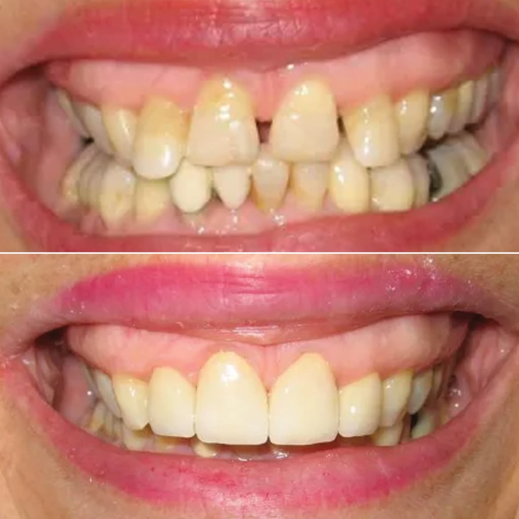 4 Front Teeth Crowns