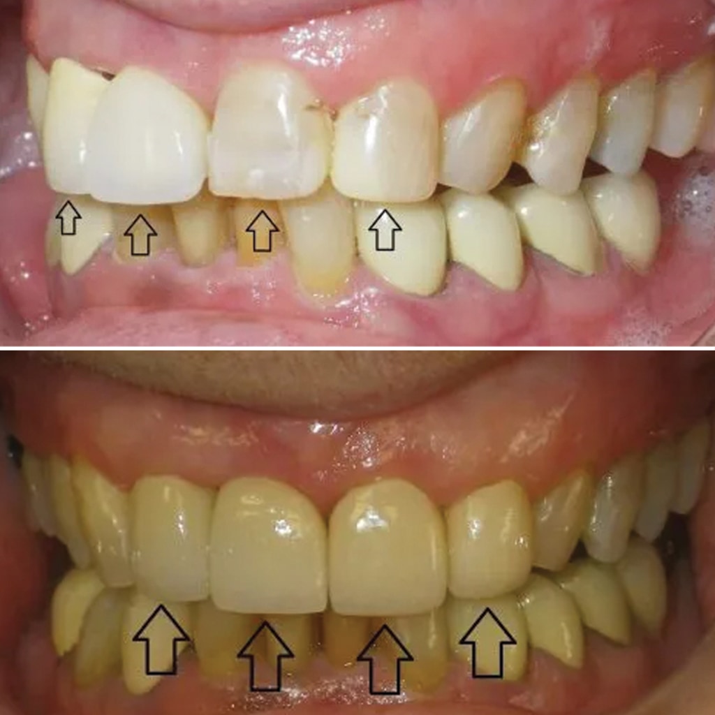 4 Porcelain Crowns
