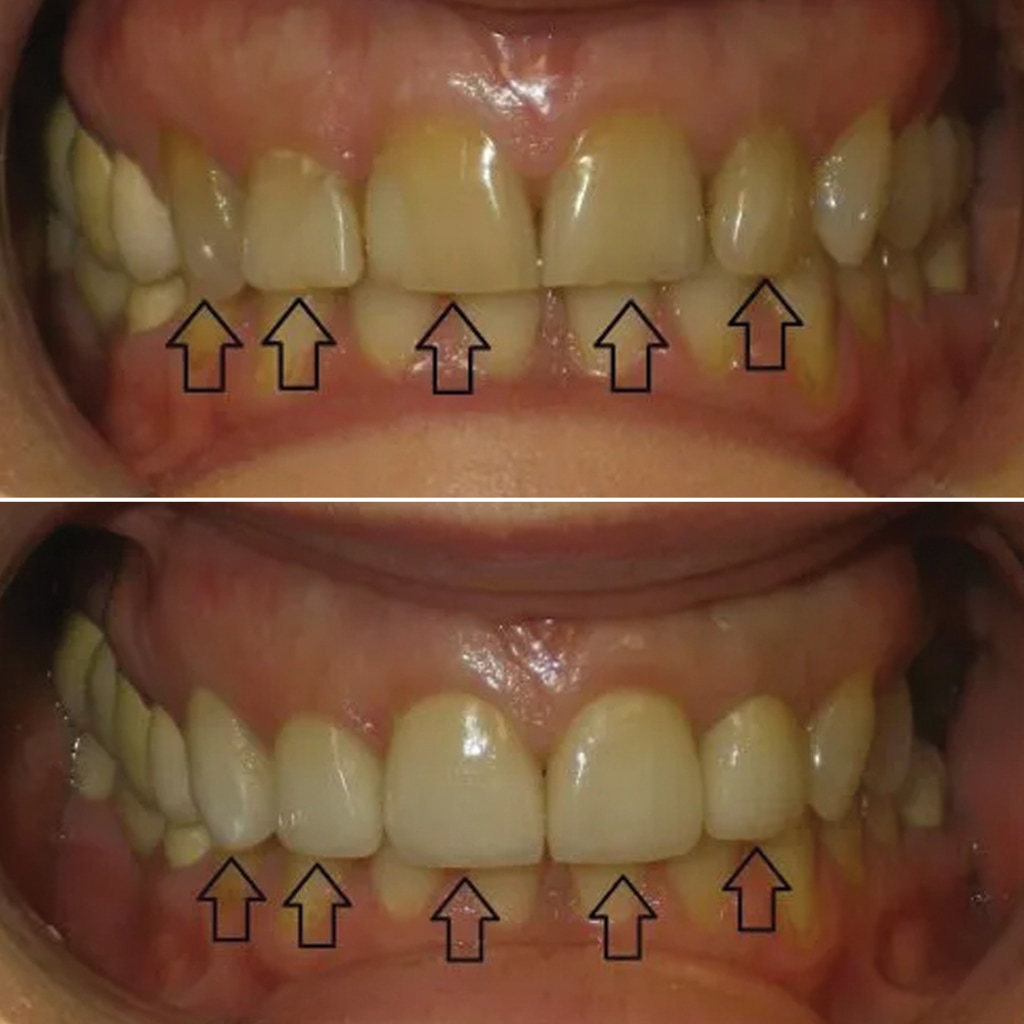 5 Ceramic Crowns