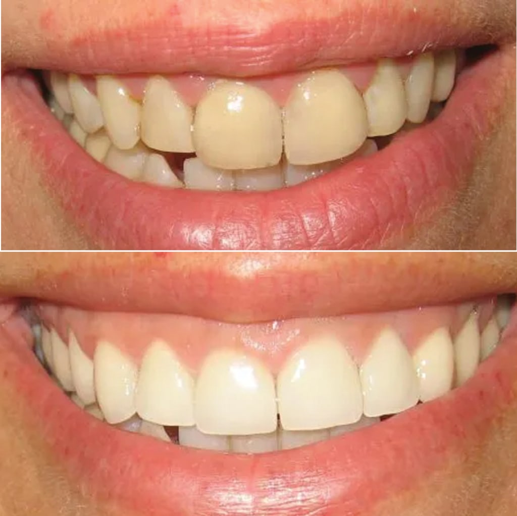 7 Upper Porcelain Crowns