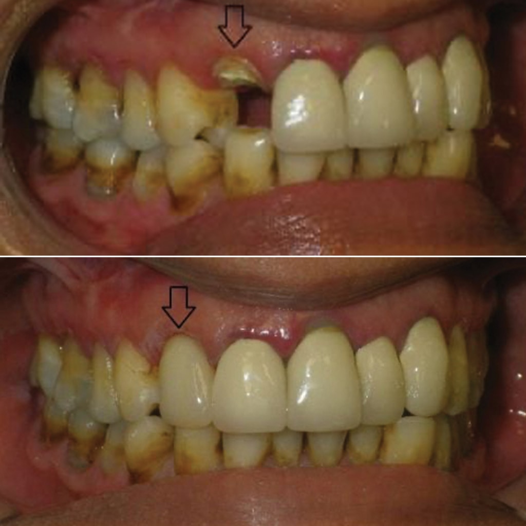 Broken Front Tooth Crowned