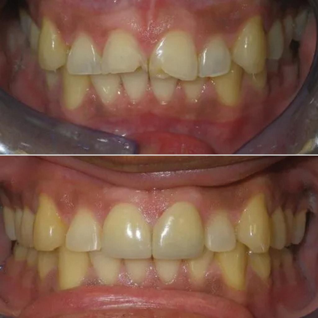 Chipped Front Teeth Restored with 2 Porcelain Crowns and Bonding