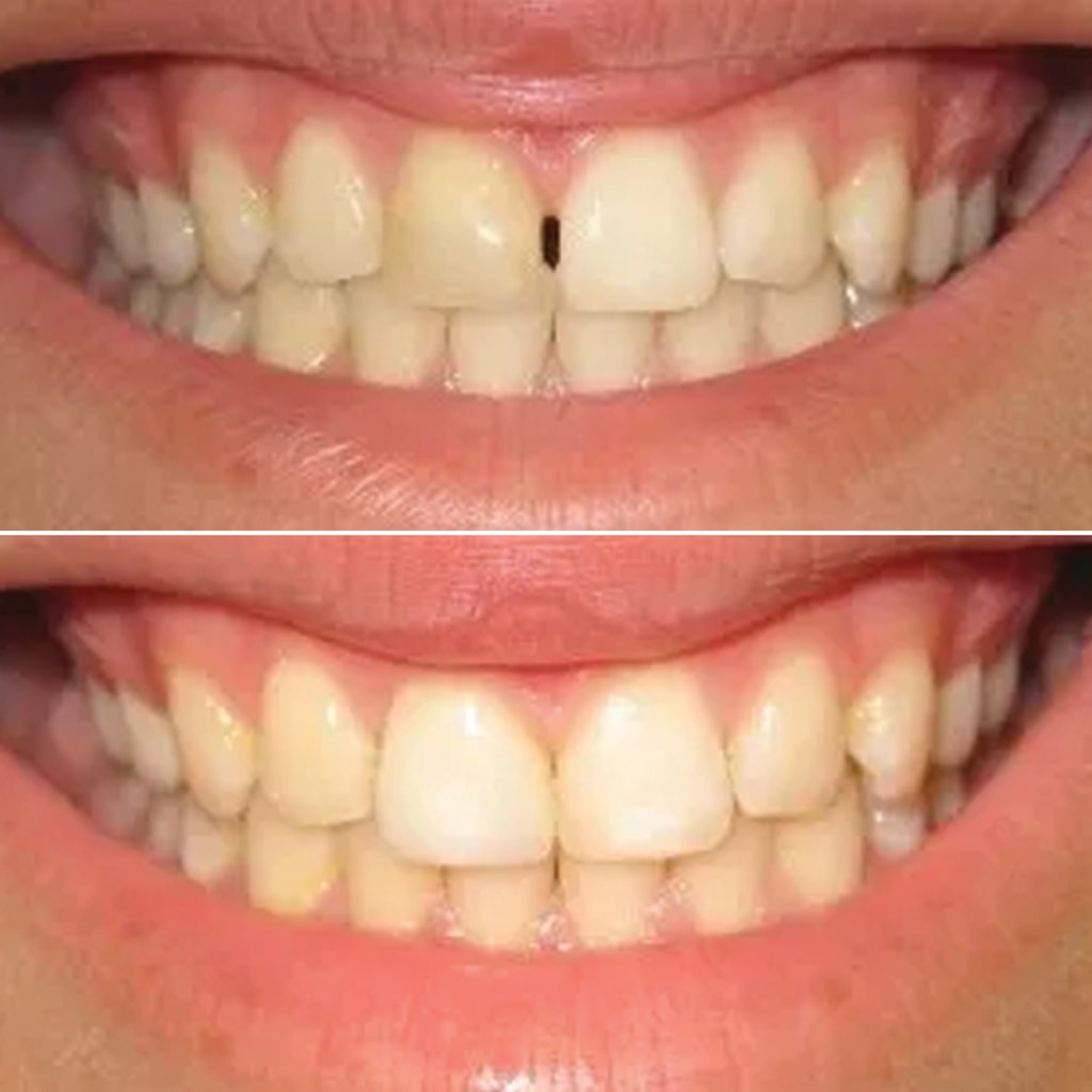 Old Bonding and Large Gap Repaired With an All Ceramic Crown