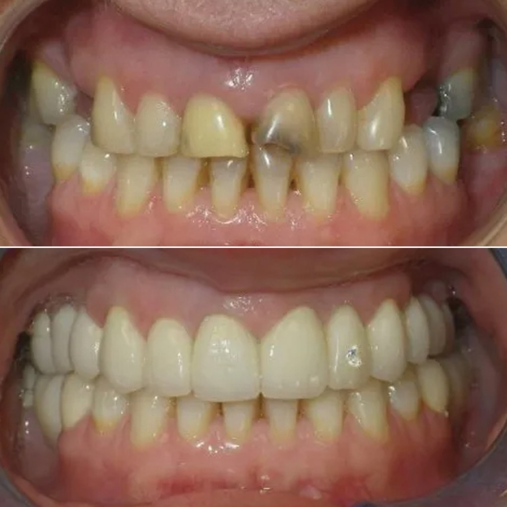 Porcelain Crowns and Bridges