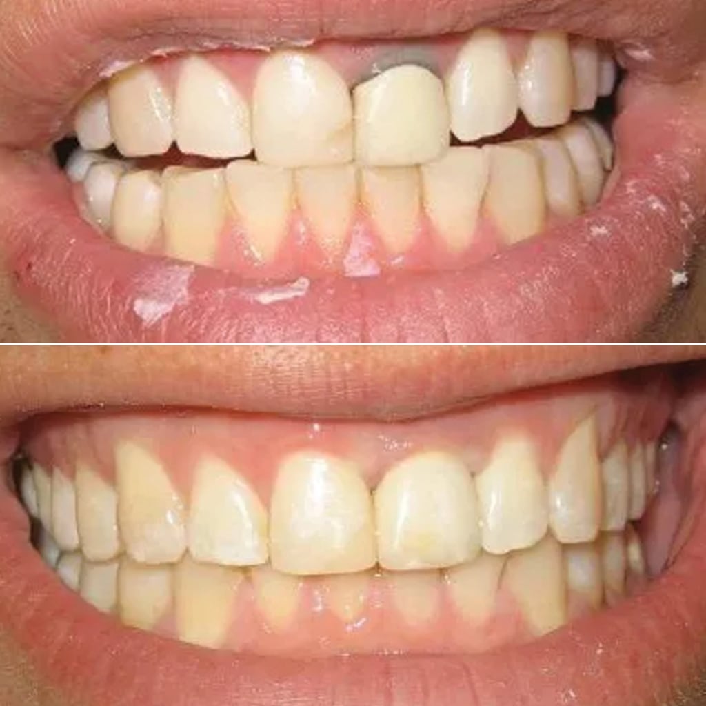Replacement of Old Crown With an All-Ceramic Crown