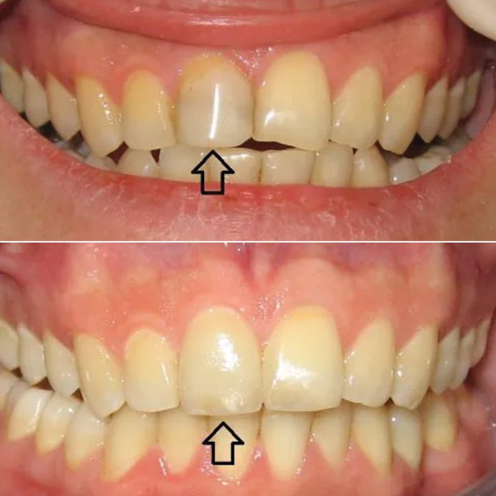 Upper Front Tooth Crown