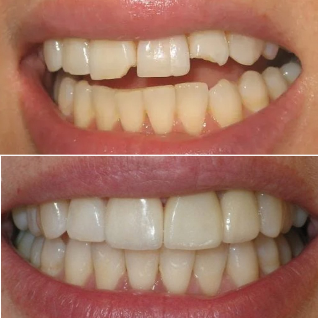 Upper Veneers and Crowns