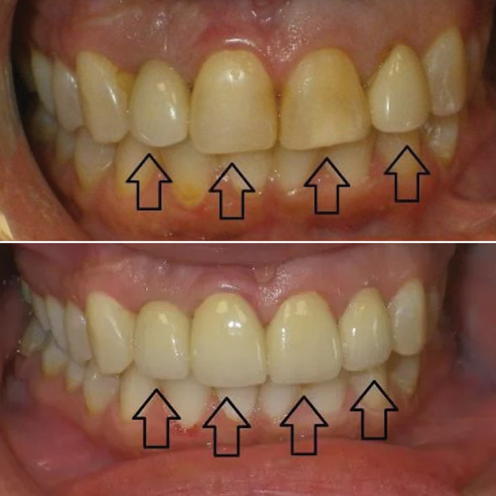 3 Crowns and 1 Implant Crown