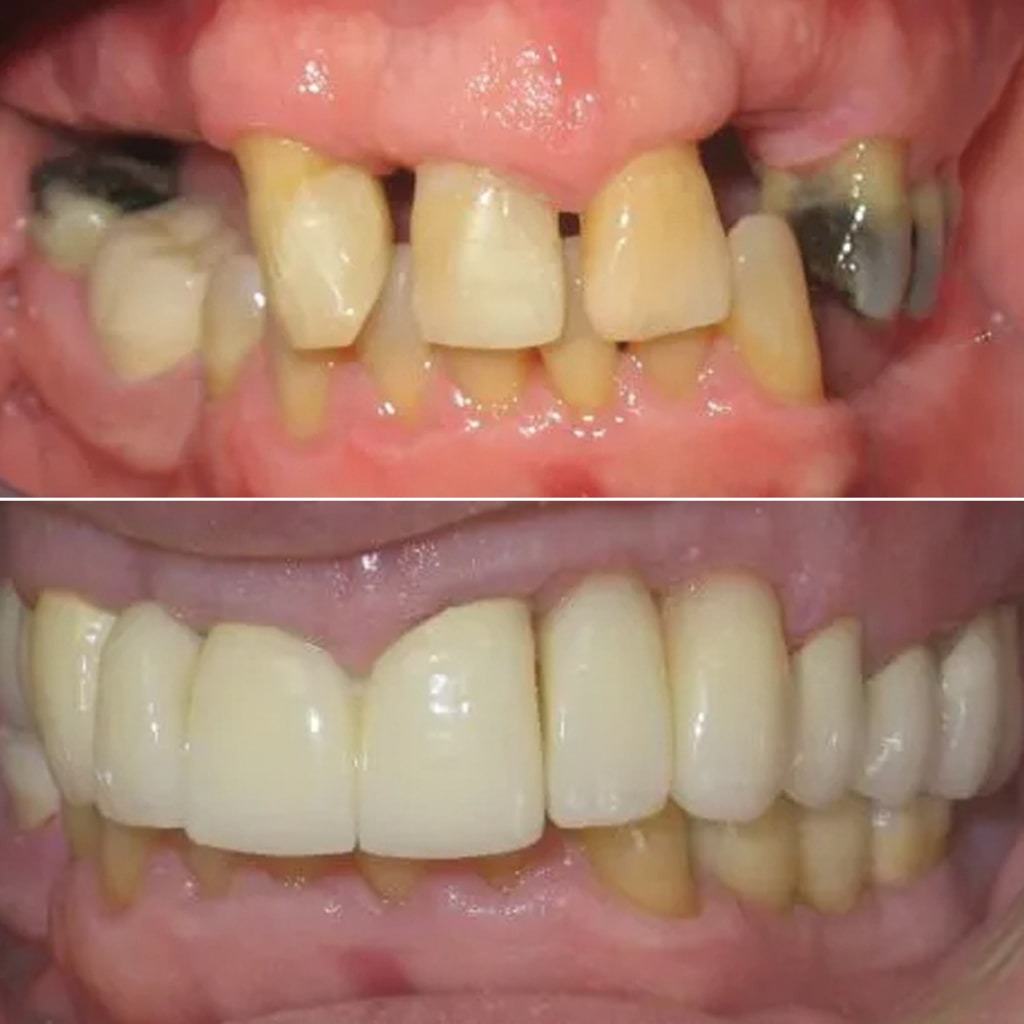 Full mouth rehabilitation involving multiple implants & crowns