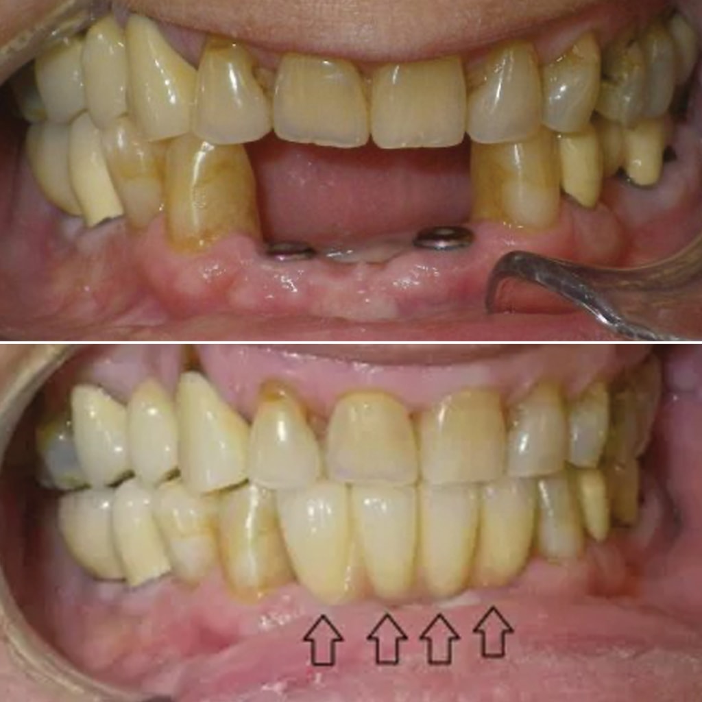 Implant Crowns