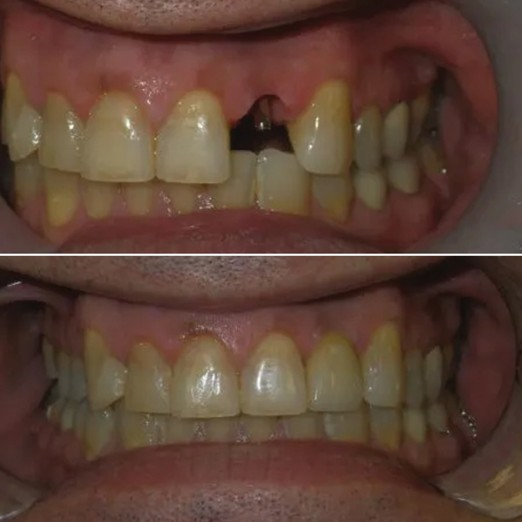 Sculpted and Healed Gums – Temporary Peg