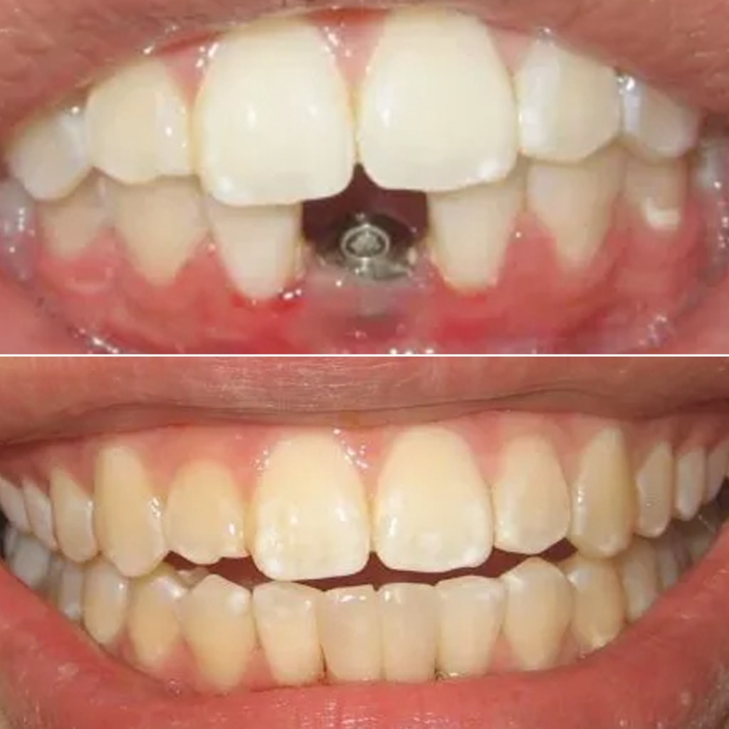 Single implant, two teeth